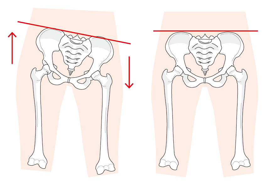 骨盤の左右傾斜のイラスト